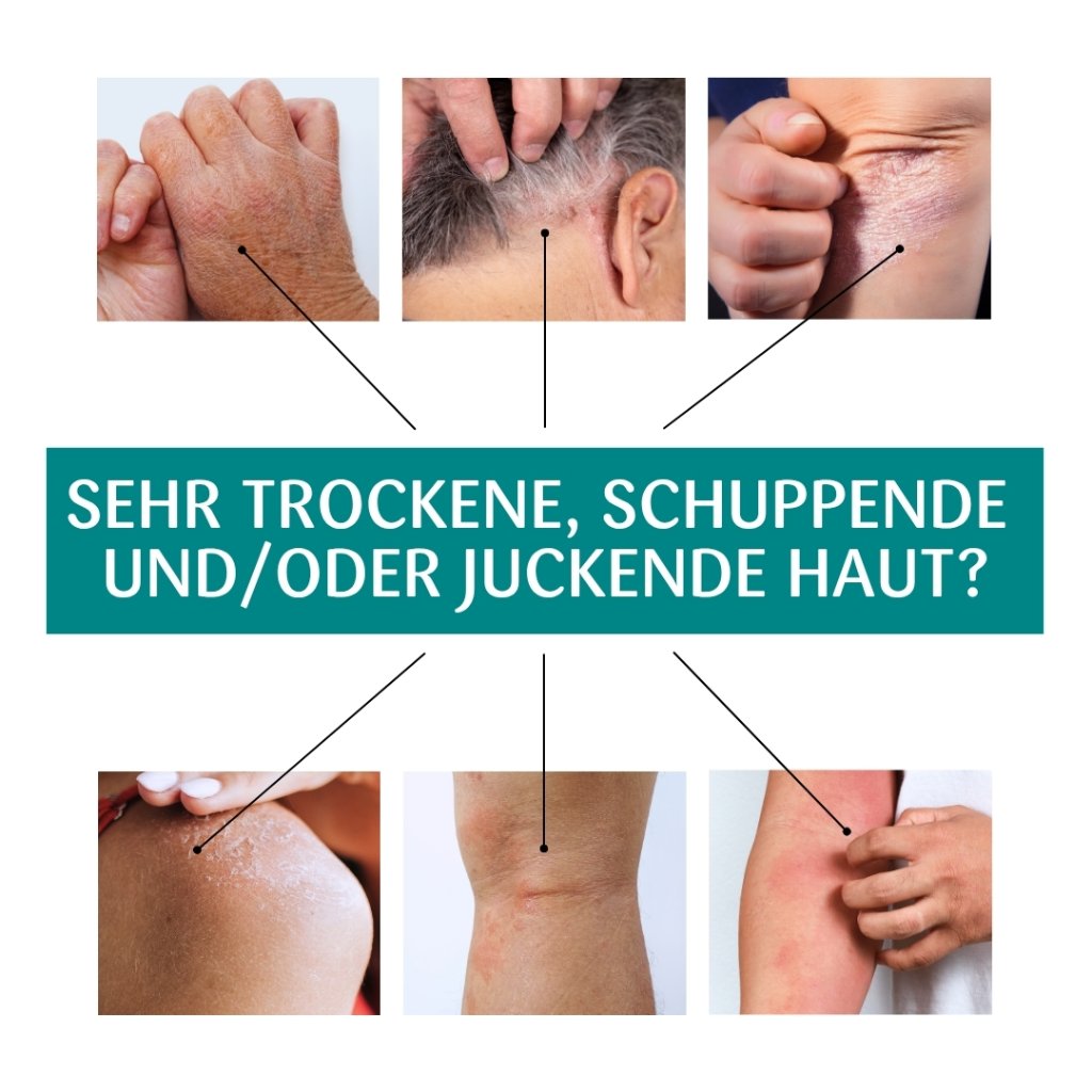 Pflege bei sehr trockener Haut, Juckreiz & Schuppung – mit 10 % Urea