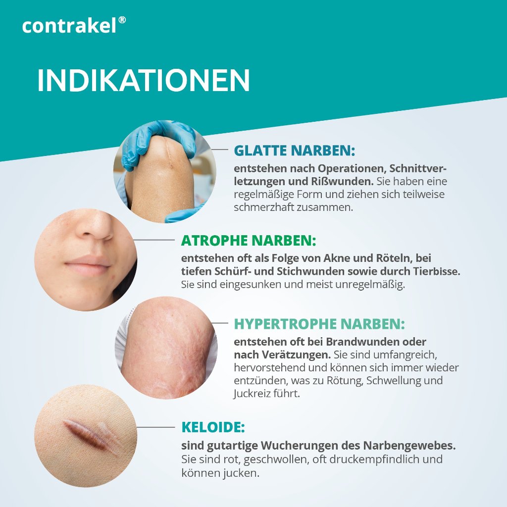 CONTRAKEL Narbencreme mit Kelosun Sonnenschutz