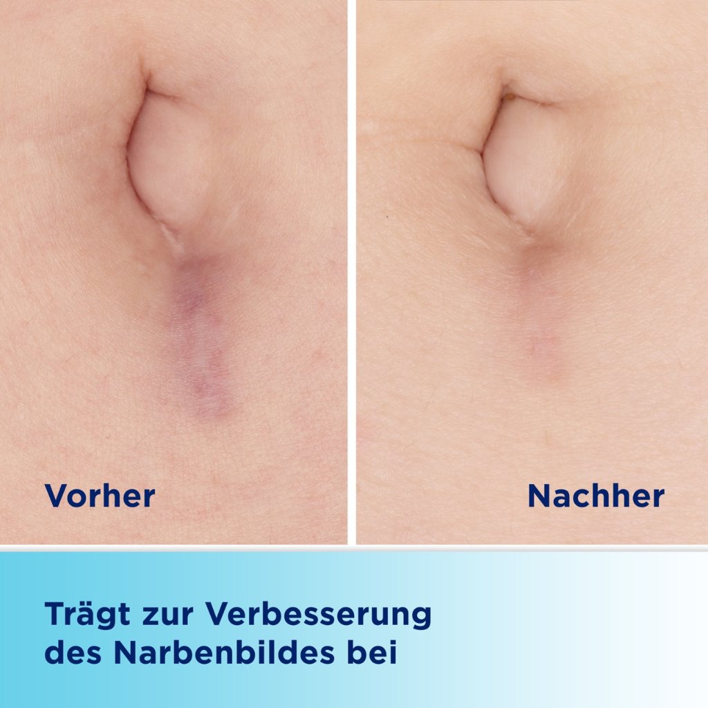 BEPANCARE Narben-Gel