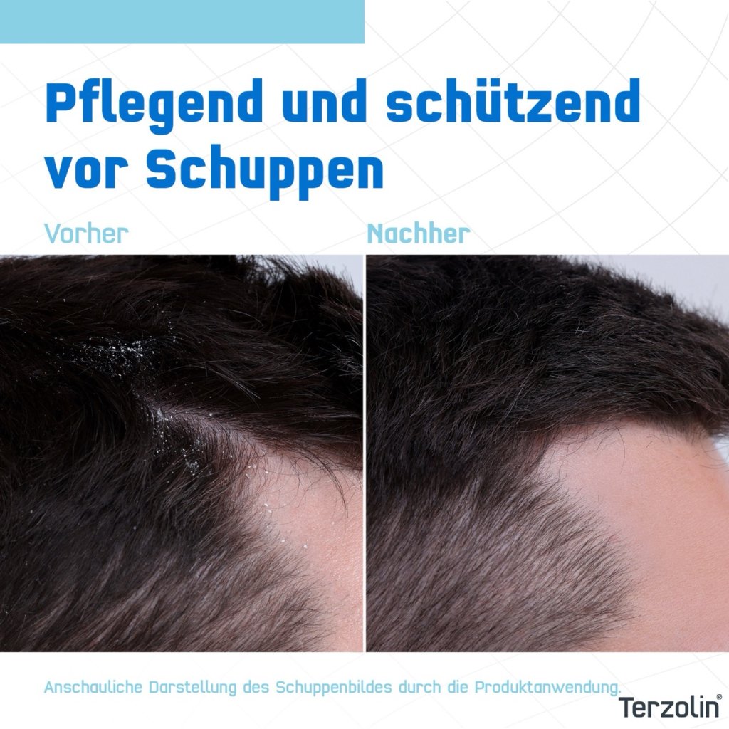 TERZOLIN Expert Shampoo bei trockener Kopfhaut