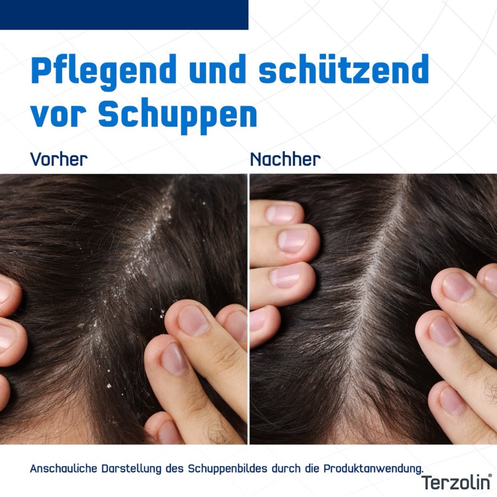 TERZOLIN Expert Shampoo bei fettiger Kopfhaut