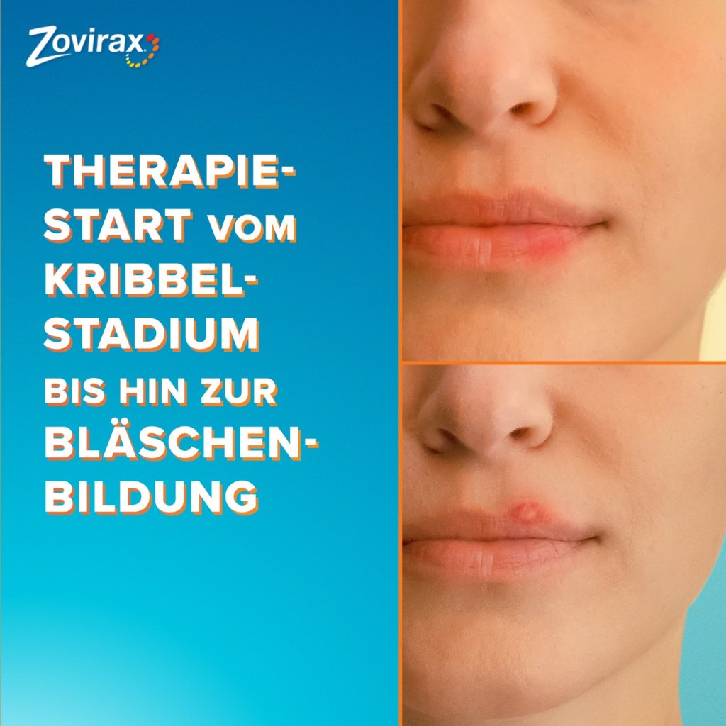 ZOVIRAX Lippenherpes Creme